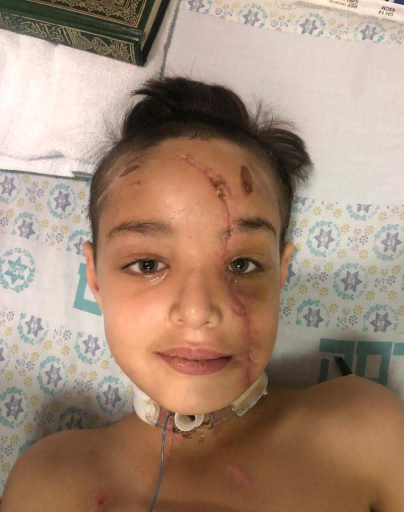 Yusef, de 10 años, ya en buen proceso de recuperación. Un milagro de salvación.